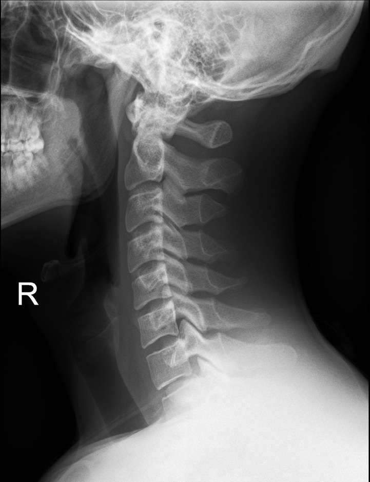 Radiographie d'une colonne cervicale normale